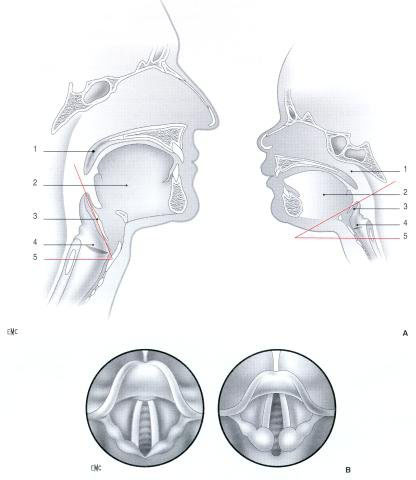 Comparaison entre voies aériennes de l'adulte (à gauche) et de l'enfant (à droite) (d'après Riazi [139]). 1. Palais ; 2. langue ; 3. épiglotte ; 4. cordes vocales ; 5. angle épiglotte-glotte. B. Orifice glottique de l'adulte (à gauche) et de l'enfant (à droite).