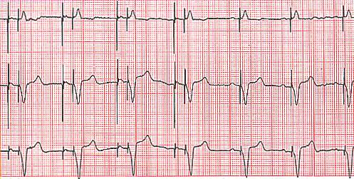 Entraînement de l'oreillette et du ventricule par le PM puis détection de l'oreillette et entraînement du ventricule.